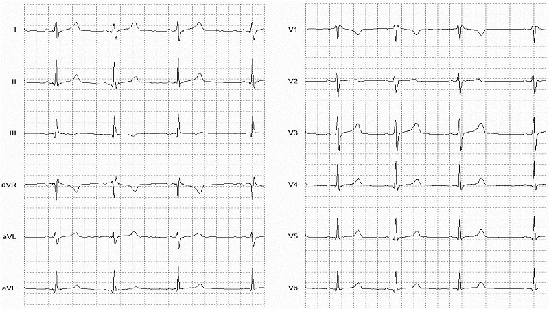 Sinus Arrhythmia12 Lead EKG